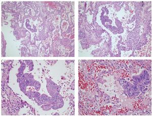 Figure from article: Prognostic impact of spread...