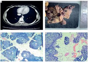 Figure from article: The hidden tumour: giant...