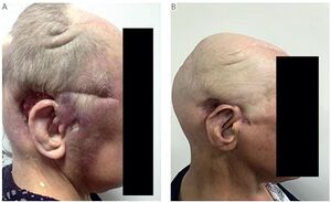 Figure from article: Case report of locally...