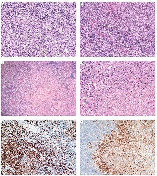 Figure from article: Atypical lymph node...