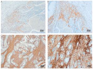 Figure from article: Prognostic impact of tumour...