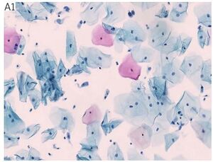 Figure from article: p16/Ki-67 dual-stain...