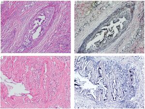 Figure from article: Extramural venous invasion...
